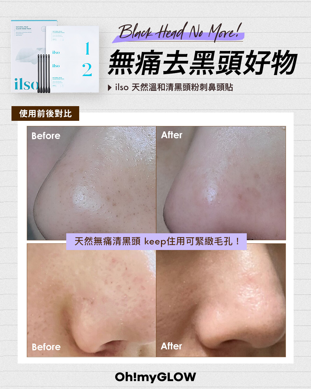 💁🏻♀️ 韓國女生推爆的拯救黑頭好物🧼 追求溫和潔淨必看!ft. ilso 無痛去黑頭粉刺收毛孔鼻貼