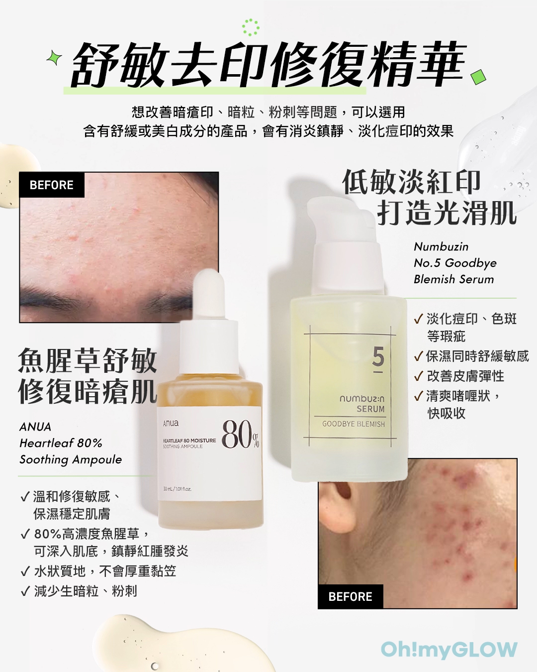 暗瘡KILLER大合集 全方位KO暗瘡﹑胸痘﹑背痘的好物推薦 舒敏去印修復精華 ANUA Heartleaf 80% Soothing Ampoule 80%高濃度魚腥草修護保濕安瓶精華 – 30ml 魚腥草舒敏 修復暗瘡肌 numbuzin No.5 Goodbye Blemish Serum 5號告別瑕疵精華 – 50ml 低敏淡紅肌 打造光滑肌 BEFORE